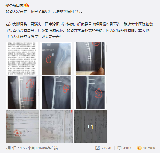 女性骨折后骨骼越来越短 求助:就医7年后