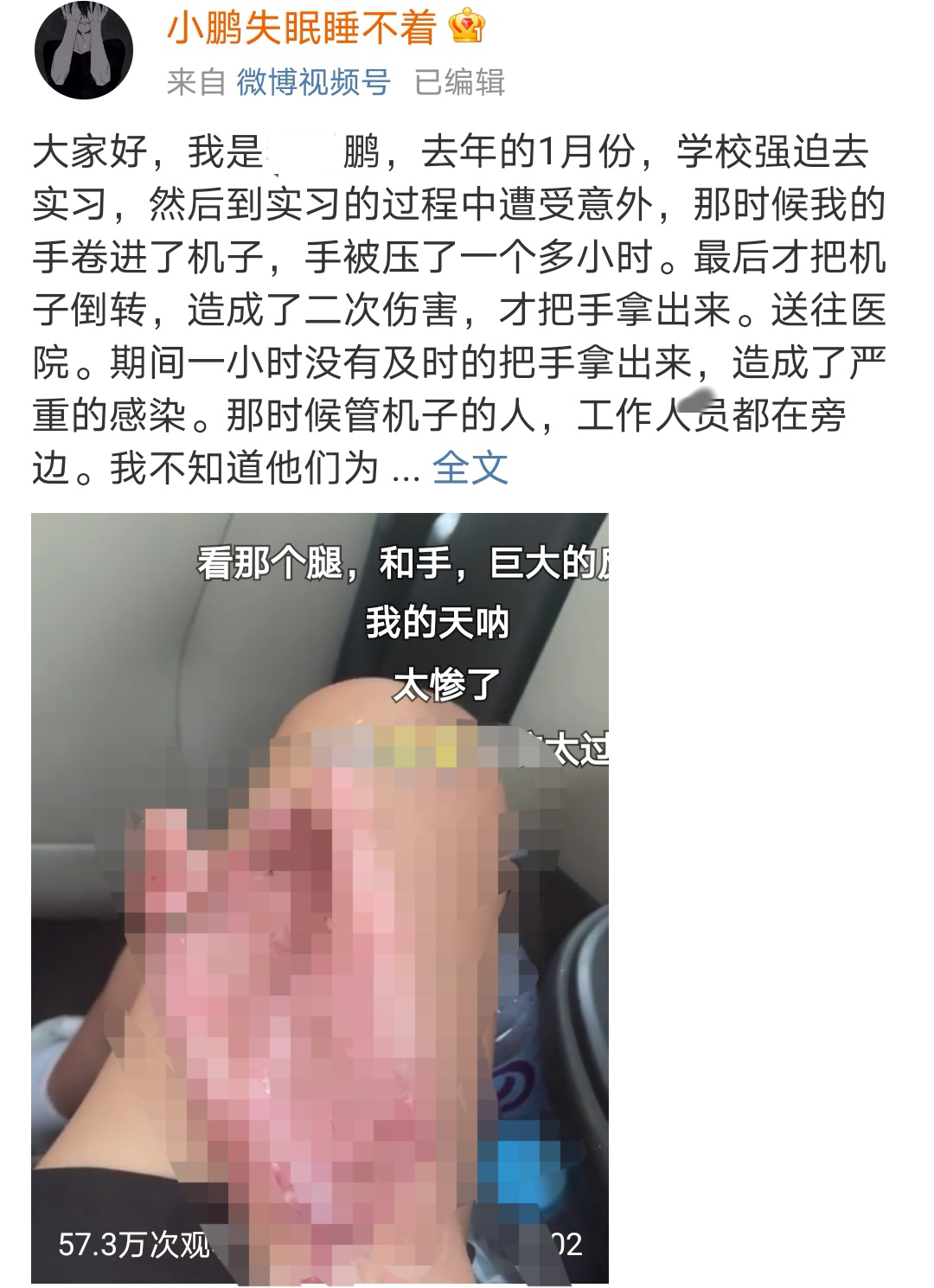 学生声称工厂实习期间手指残疾后续处理不合