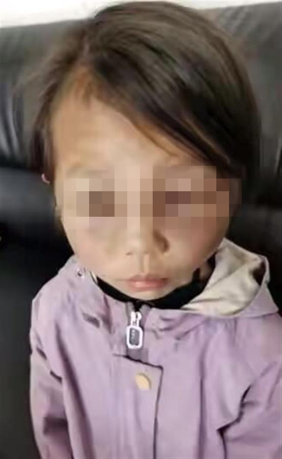 云南一女孩被怀孕的继母虐待 当地妇联:走